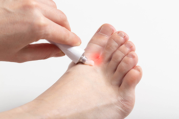 Athlete's Foot (Tinea pedis): Symptoms, Causes & Treatment - Foot