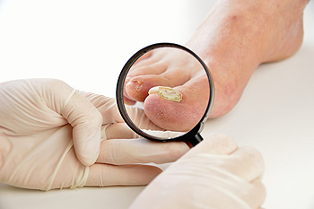 Fungal Nail Infections, Causes, Symptoms & Treatment