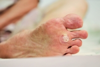 Treatment of Plantar Warts