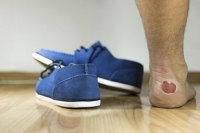 Foot Blisters May Require Treatment