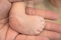 Clubfoot May Affect One or Both Feet